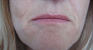 Injectable sculptra