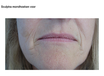 Sculptra voor