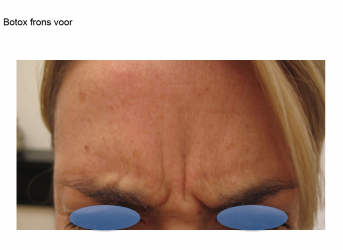 Botox voor Botox voor