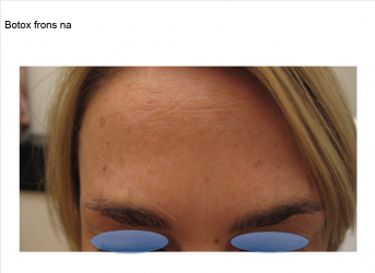 Botox na Botox na