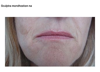 Sculptra na Sculptra na